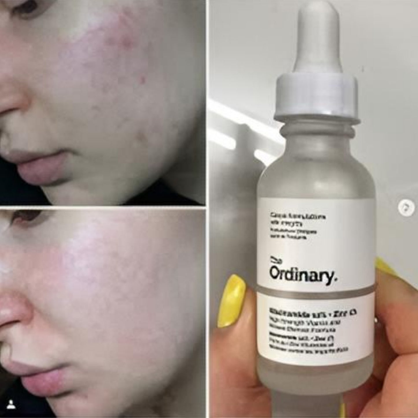 The Ordinary Niacinamide 10% + Zinc 1 % - 30ml Serum
